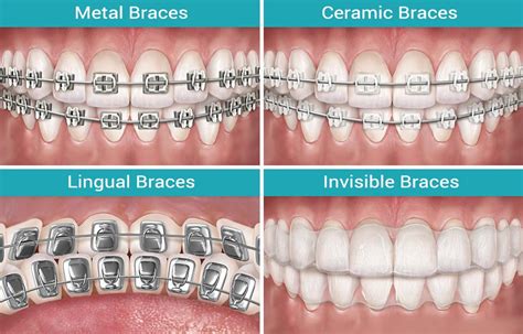 what type of braces are the cheapest